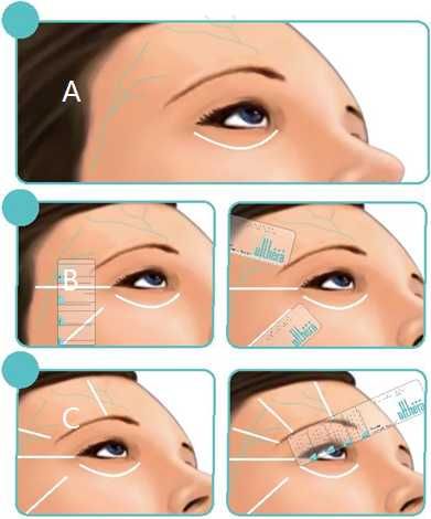 Аппарат HIFU для SMAS-лифтинга Lift Pro body hifu, 5 катріджів