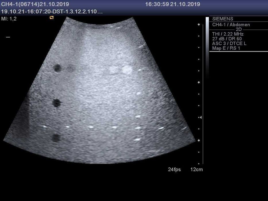 Конвексний датчик УЗД Siemens (Acuson) CH4-1