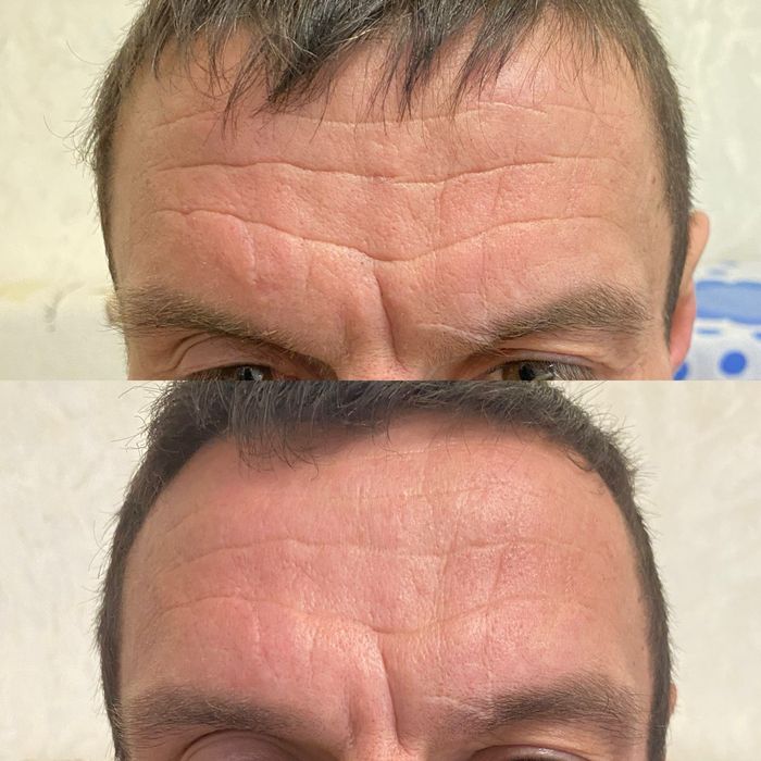 Косметолог. Ботокс, губи, векторний ліфтінг.