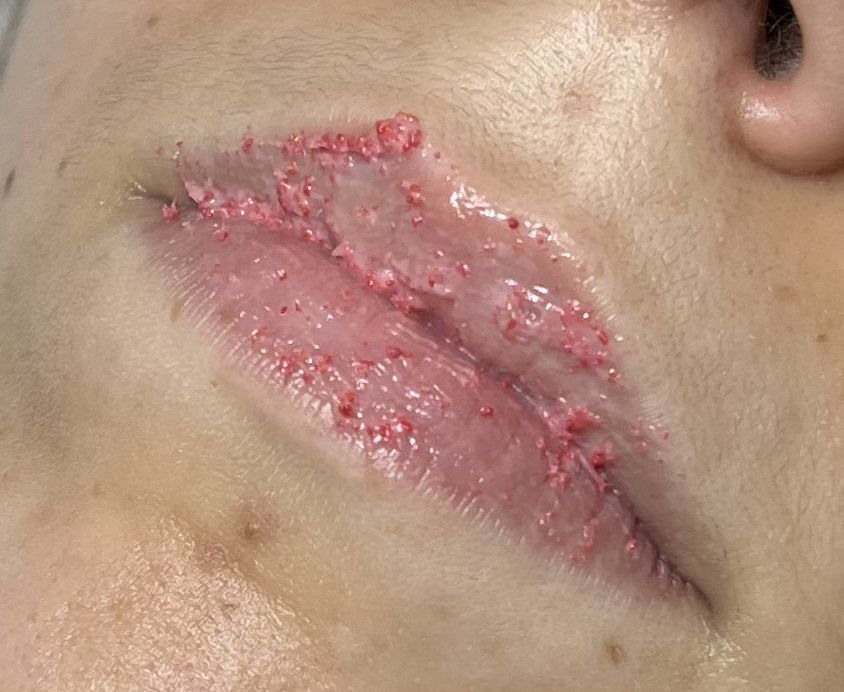 Serviço de Hydra lips