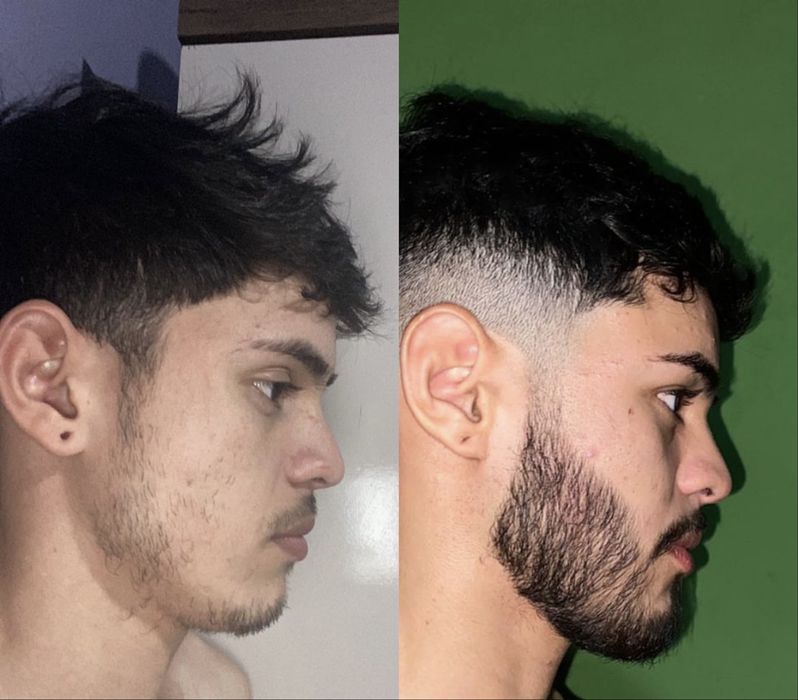 Minoxidil kirkland e Foligain extra forte