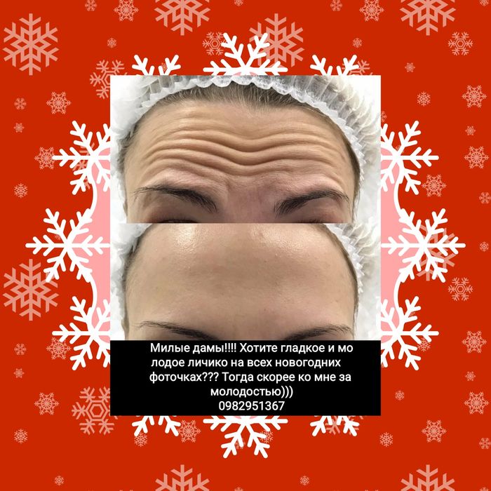 Ботулинотерапия! Гладкое личико! Ботокс!