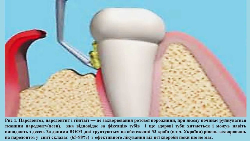 Profilaktyczna guma do żucia na bazie miodu і wosku  od paradontozy