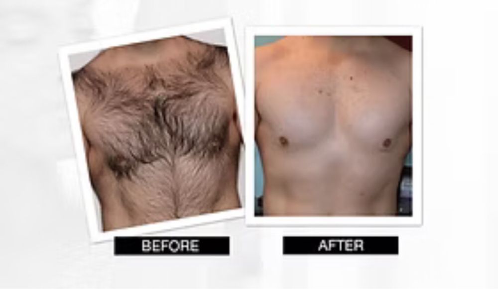 Depilaçao masculina : laser , cera e maquina de aparar .
