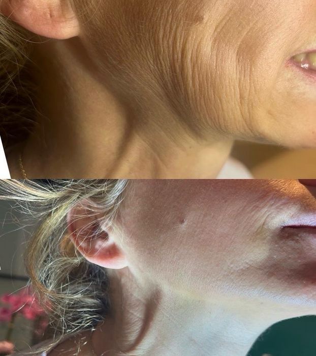 -50% BTX/ botoks/ botox/ powiększanie ust