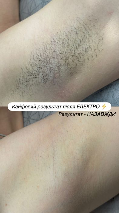 Професійна Лазерна епіляція, ЕЛЕКТРОепіляція ПОКРОВ