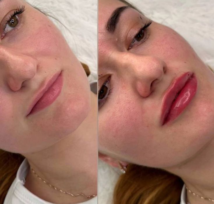 Акція!!Збільшення губ від 2500 грн,Ботокс