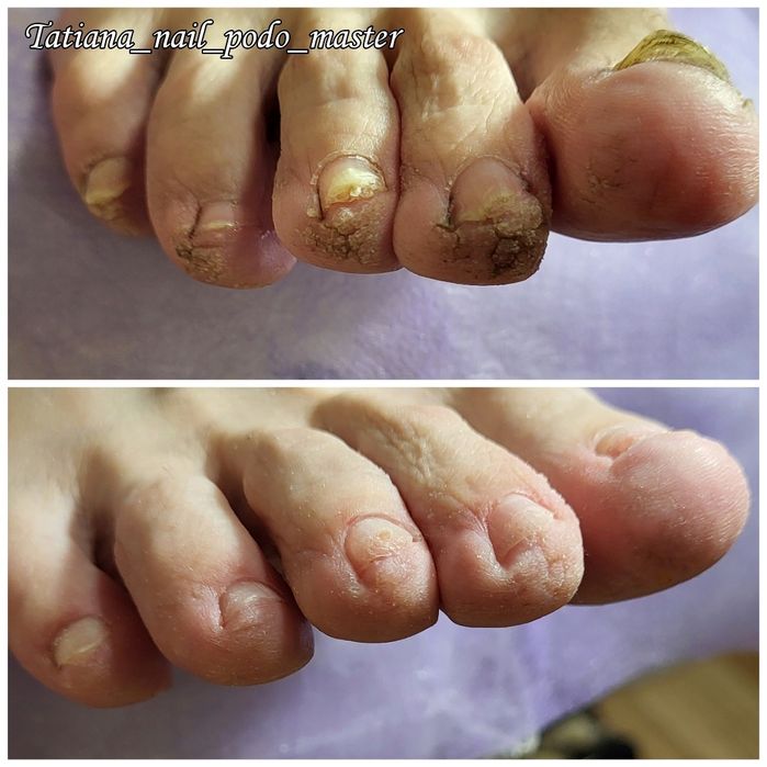 Подолог. Бородавки. Вросший ноготь. Мозоли. Грибок