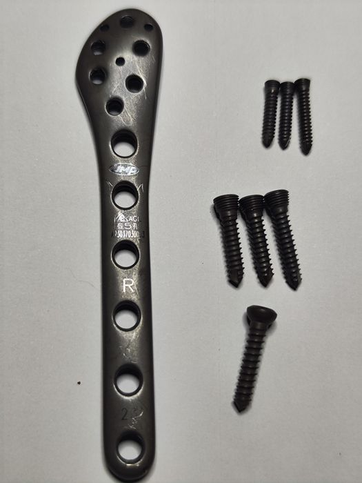 Титанова пластина для остеосинтезу малогомілкової кістки