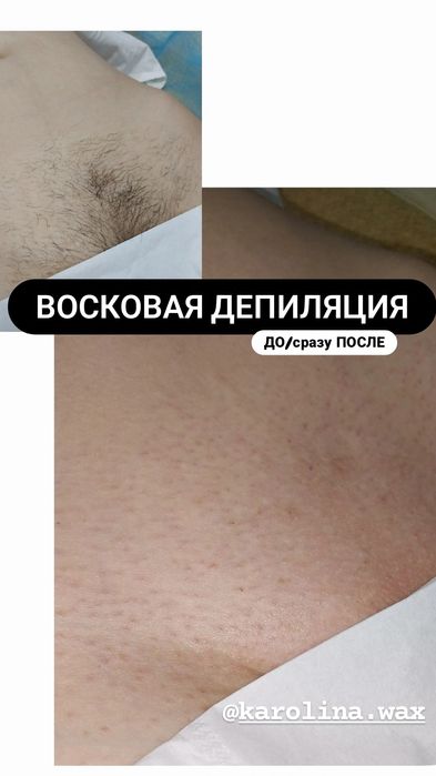 Електроепіляція та воскова депіляція. 10 років досвіду. Центр Бучі.