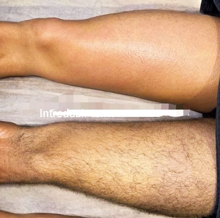 Depilação no corpo
