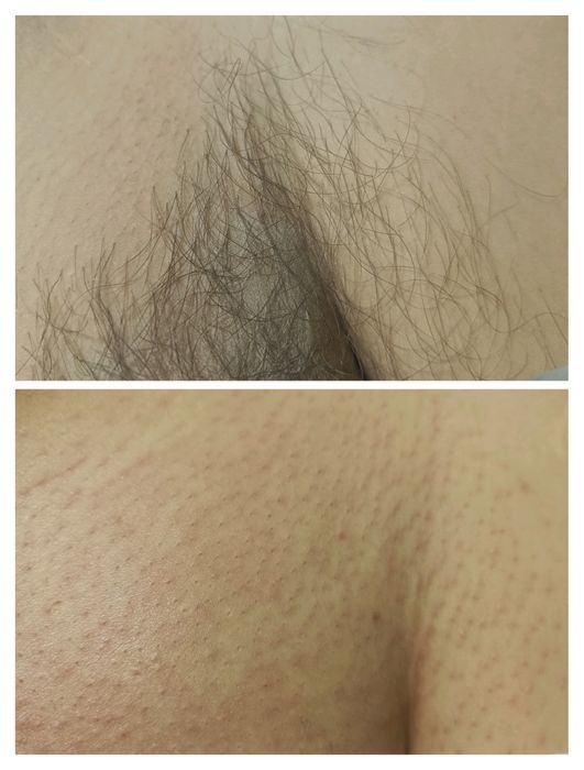 Депіляція для чоловіків, всі  зони