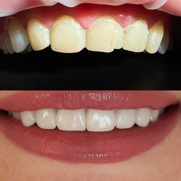 Виготовлення коронок з діоксид цирконію