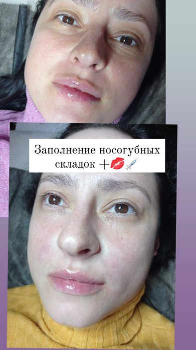 Ботокс, Контурная пластика Услуги косметолога.