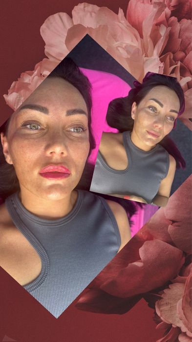 Увелечения Губ Контурная пластика