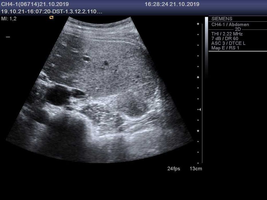 Конвексний датчик УЗД Siemens (Acuson) CH4-1