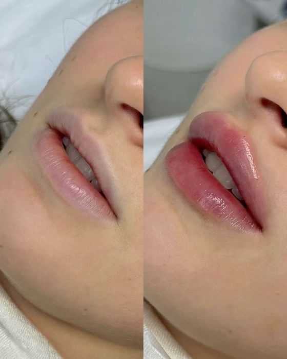 Powiększanie ust, botoks btx, medycyna estetyczna MOBILNIE I STACJONAR