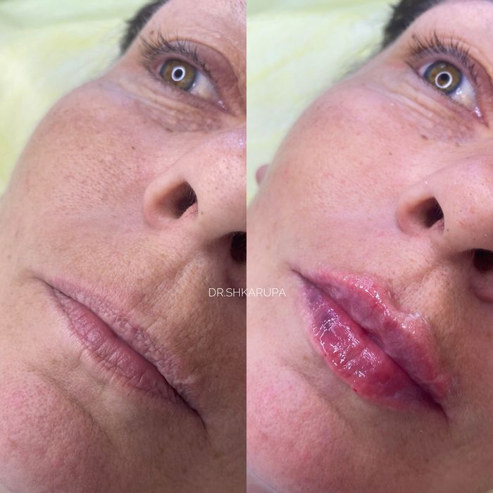 АКЦІЯ! Контурна пластика губ / збільшення губ / увеличение губ