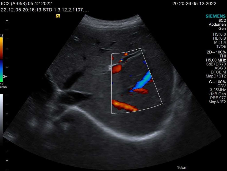 Конвексний датчик УЗД Siemens (Acuson) 6C2