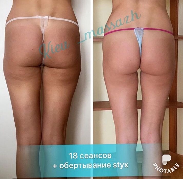 Антицеллюлитный массаж ЖК София