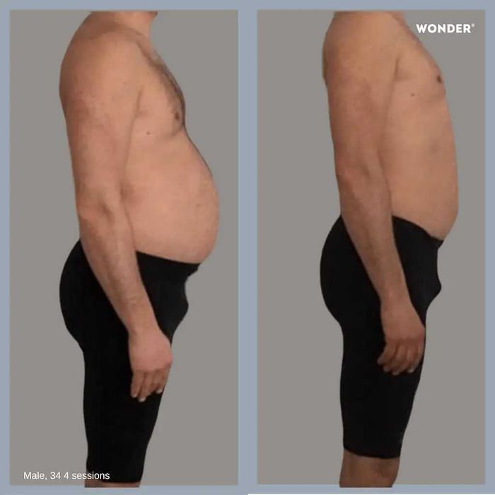 Wonder Prestige EMS Neuromuscular como novo