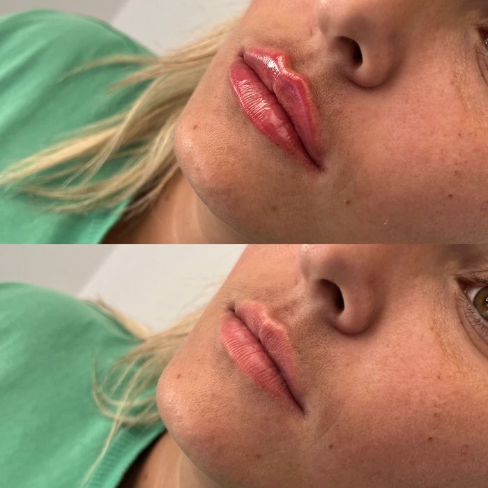 Збільшення губ Печерськ 5200 грн