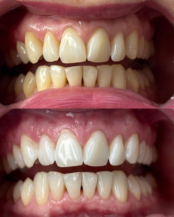 Kosmetyczne wybielanie zębów