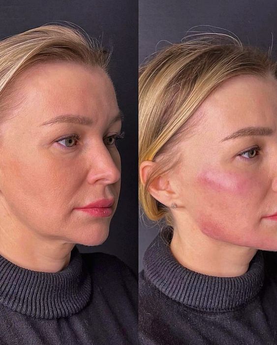 Похудение,ботокс,губы,рф,смасс,косметолог