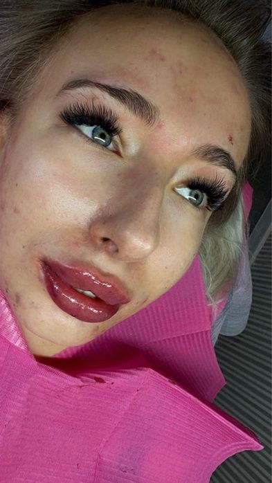 Modelowanie i powiększanie UST - 300 zł. 1 ml.