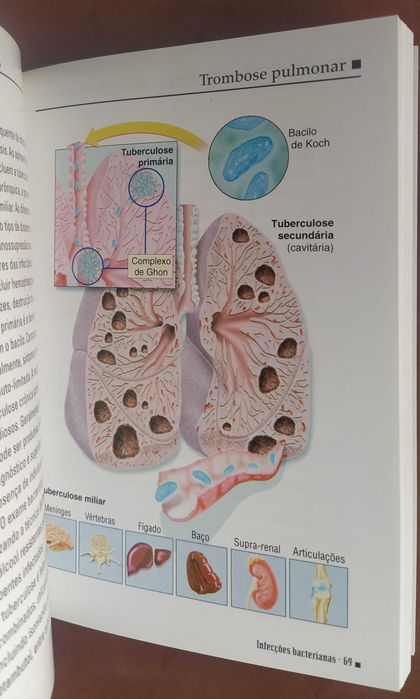 Infecções bacterianas-Miniatlas