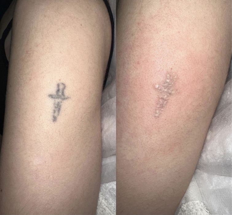 Видалення татуювання, перманенту