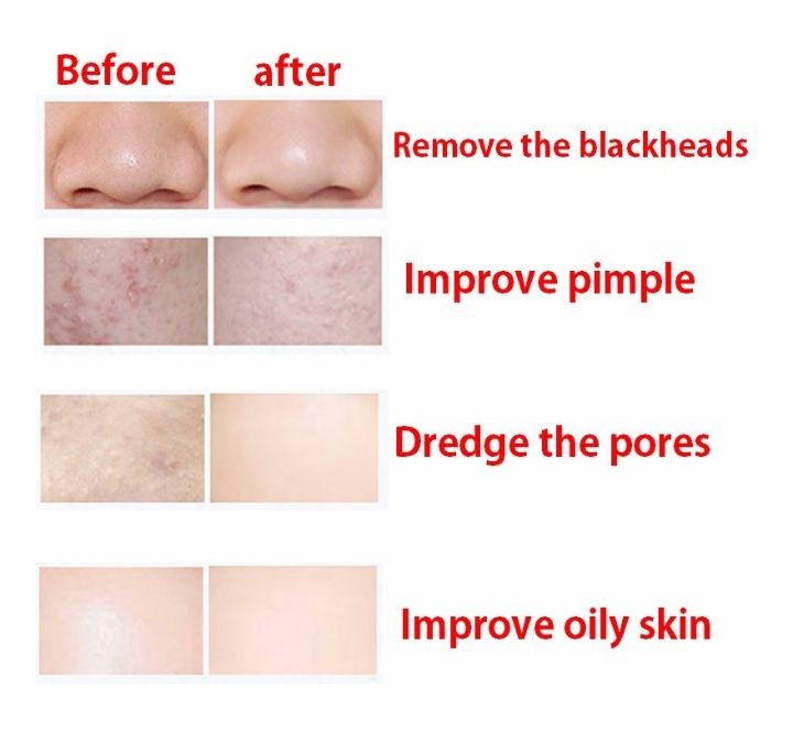 Espátula Ultrasonica Peeling Ultra Sonica Nova Limpeza de Pele