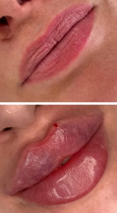PROMOCJA powiększania ust 380zł , btx , Stymulatory