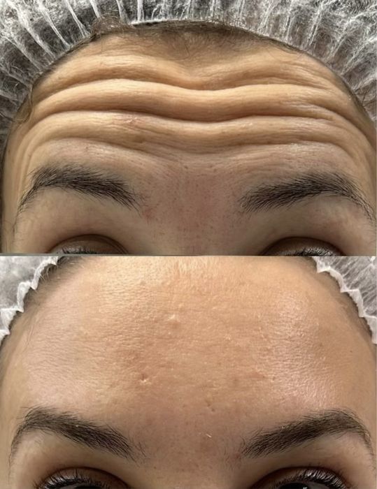 Ботулінотерапія по собівартості, модель ботокс від 500 грн АКЦІЯ