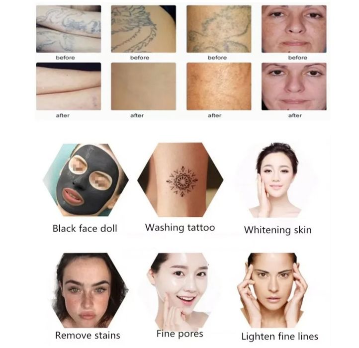 Aparelho a laser Pico sem água e não invasivo para lavagem de sobrancelhas, remoção de tatuagens e sardas em picossegundos.