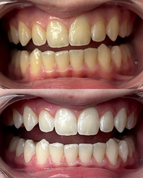 Kosmetyczne wybielanie zębów