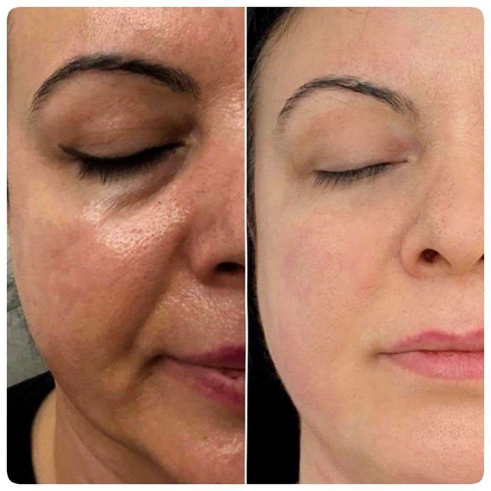 Osocze i Fibryna Kroplówki Detoks Cewnikowanie