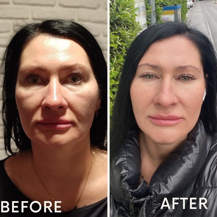 smas lifting без операційна підтяжка обличчя