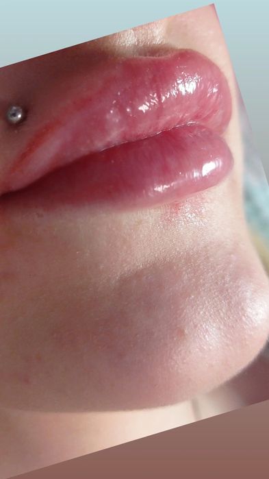 Ботокс, Контурная пластика Услуги косметолога.