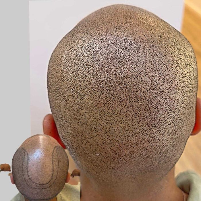 Micropigmentação capilar.