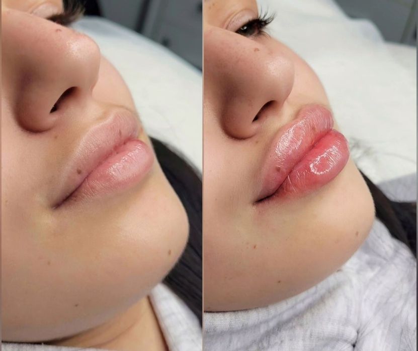 Акція!!Збільшення губ від 2500 грн,Ботокс