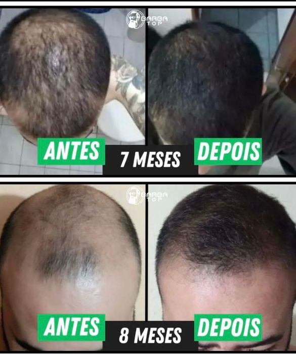 Minoxidil - original