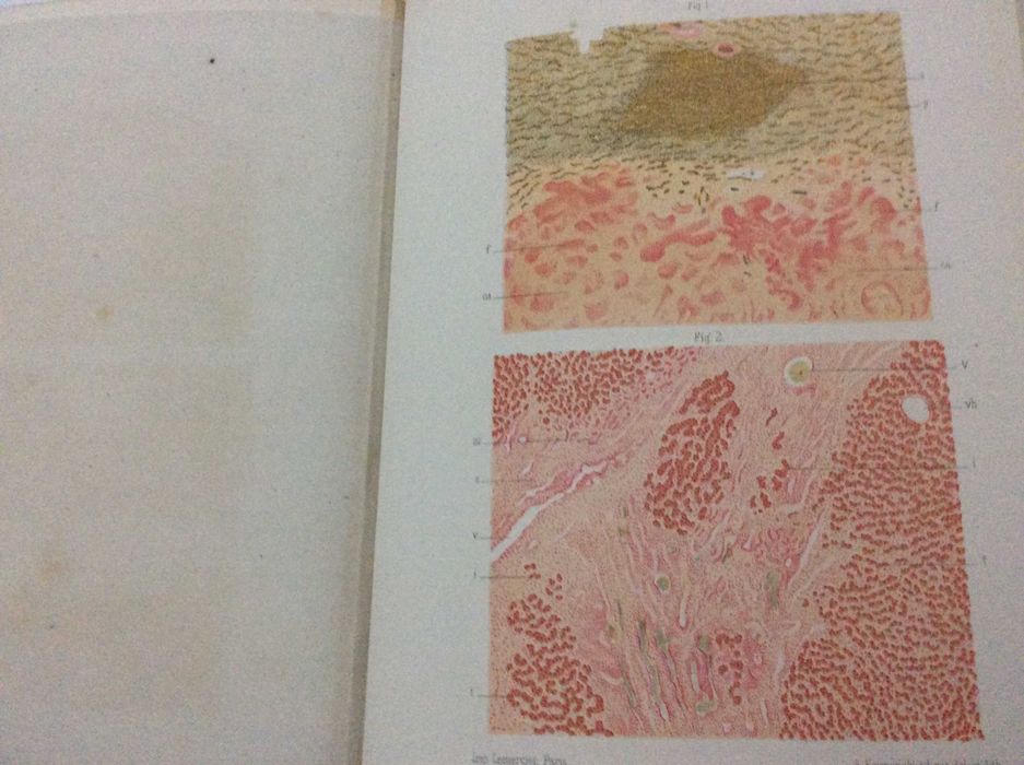 Raro exemplar. LETULLE, Maurice (1853-1929): L'Inflammation. Études anatomo-pathologiques. Rubricado pelo médico António de Padua