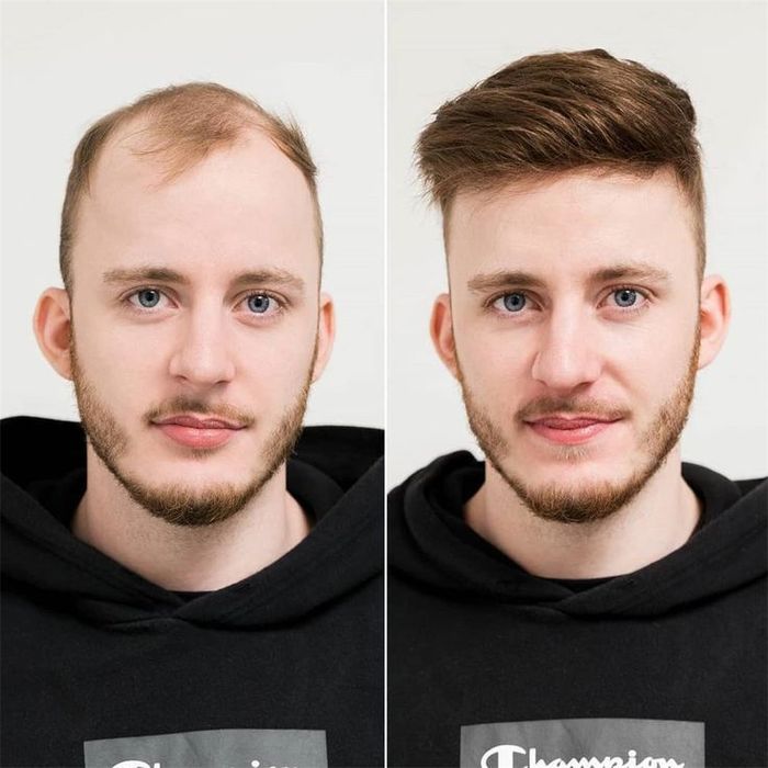 Curso Profissional de prótese capilar injetada em Alverca