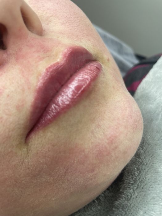 Збільшення губ троєщина 2000-1мл