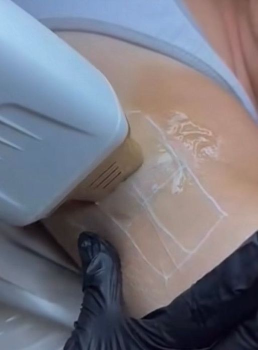 Tratamento profissional de Hifu com equipamento topo de gama