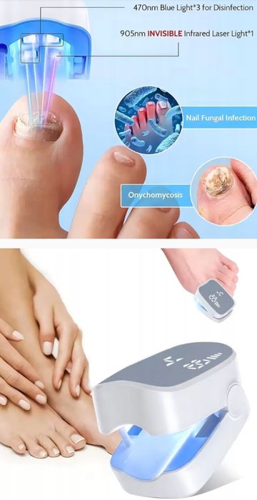 Laserowy Usuwacz grzybicy z paznokci
