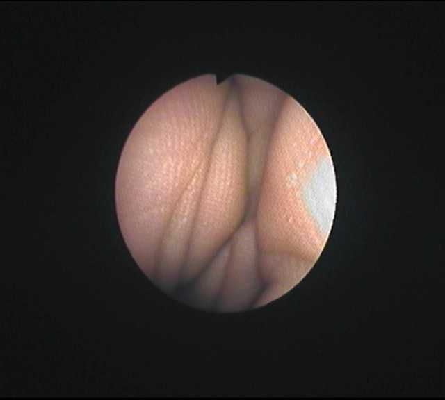 Бронхоскоп Olympus BF-P20D