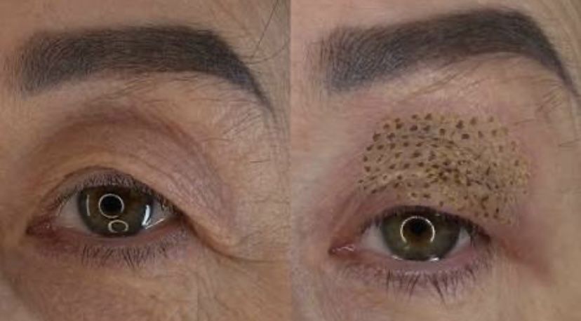 Безоперационная Блефаропластика