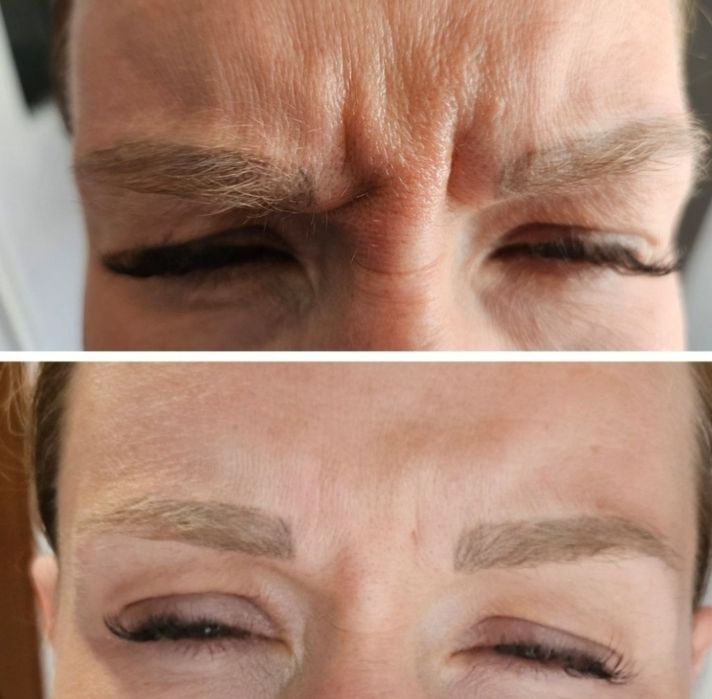 Promocja! Botox promocja 1 okolice 130zł do końca sierpnia